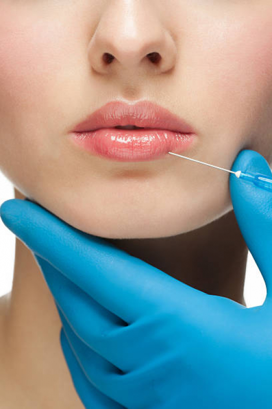 Aplicação de Botox nos Labios Marcar Vila Mariana - Aplicação de Toxina Botulínica na Face Lapa