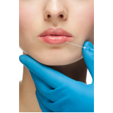 aplicação de botox nos labios marcar Sumarezinho